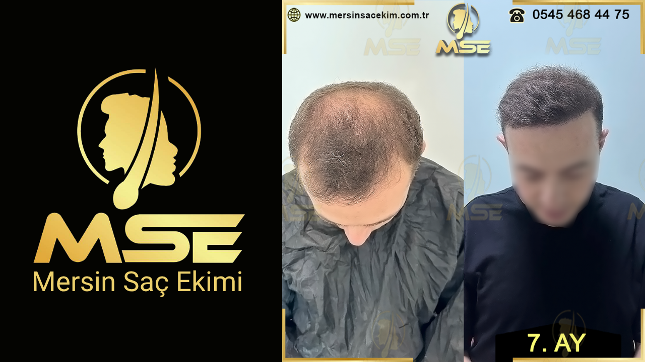 MERSİN SAÇ EKİMİ